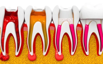 Wurzelbehandlung: Ablauf von A bis Z